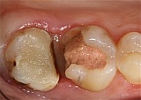 Операция удлинения коронковой части зубов