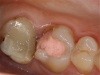 операция удлинения коронковой части зубов 16 и 17 с применением лазерной технологии.