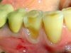 пришеечный кариес 44 зуба с глубоким расположением относительно истонченного края слизистой.
