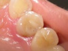 раскол коронки 14 зуба с подвижным небным участком