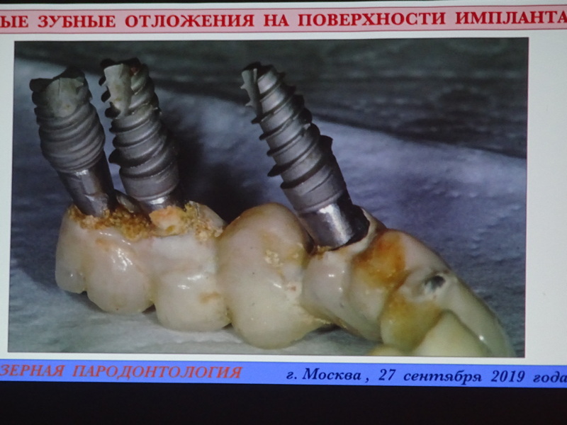Зубные отложения на поверхности импланта