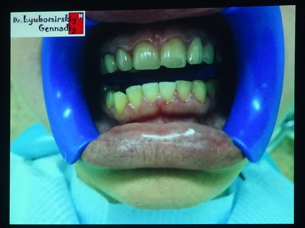 Спектр клинического применения лазера (до снятия зубных отложений, гингивиты