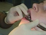 Обработка корневого канала зуба 1.2